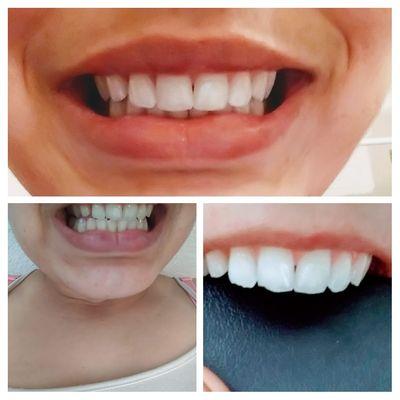 My before (lower chipped anteriors) and after all shaped very nice.  Very happy with the result! In full smiles thank you!