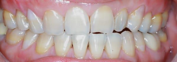 My teeth before suffering from discoloration, I had to always be careful how I smile... Now I don't thanks to Dr. Wu!