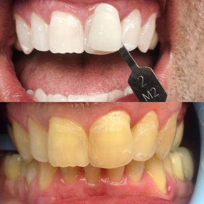 In office whitening with Zoom. Great outcome!