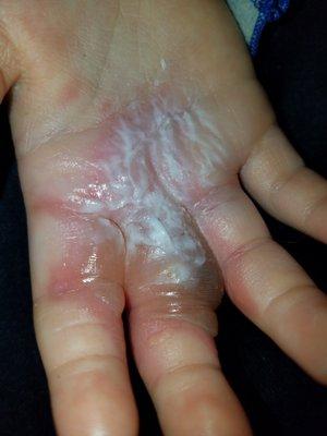 Doctor Shah Chemically Burned my 5 year olds hand when doing a simple wart removal