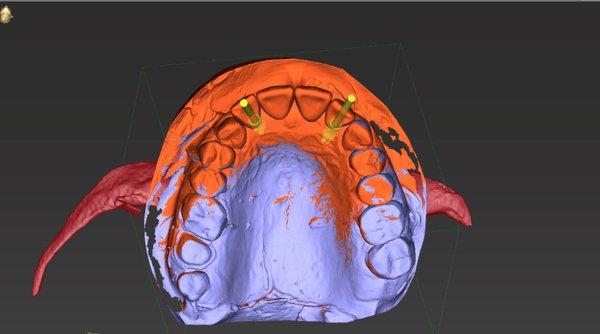 Virtual surgical planning using our iTero digital scanner and CBCT.