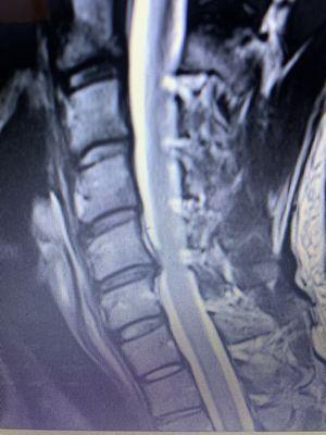 MRI of cervical disc injury