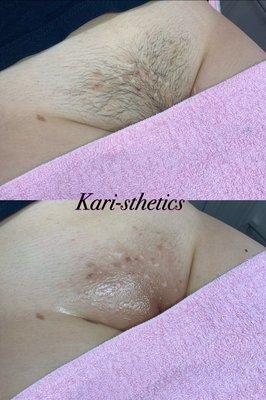 Brazilian wax