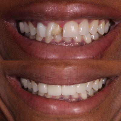 Beautiful Porcelain Veneers