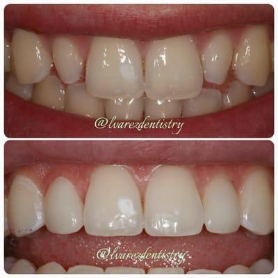 Porcelain Veneers by Dr. Alvarez