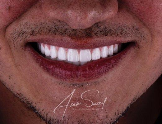 Beautiful upper and lower full arch zirconia teeth. All on 4 for the win! Isn't his smile amazing?!