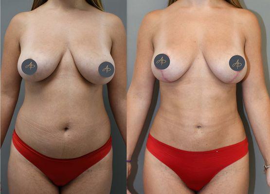 Young patient with breast lift and abdominal liposuction