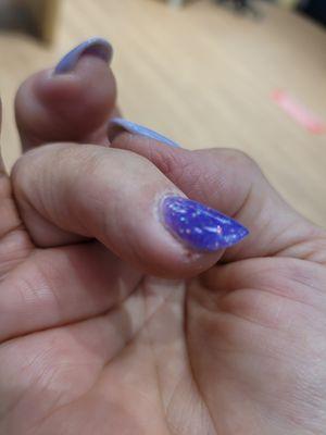 Infected Nail