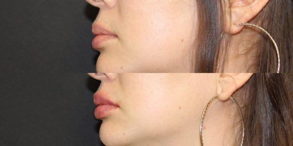 One Full Syringe Of Filler Used To Enhance Natural Pout