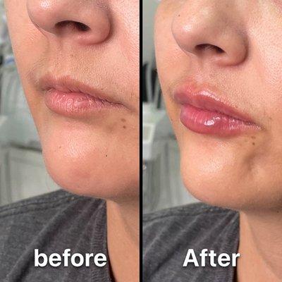 Lip filler with Juvederm