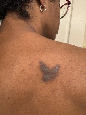 Removery Tattoo Removal & Fading