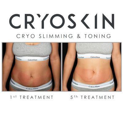 Destroy fat and lose inches, all in 30 - 40 minutes. During a CryoSlimming session the skin is warmed then rapidly cooled.