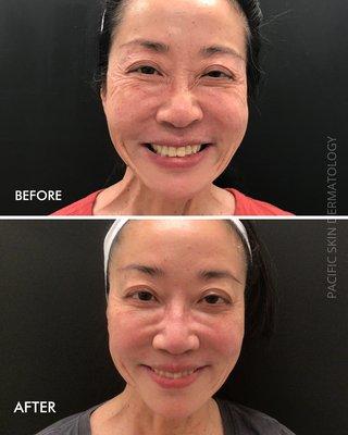 Filler and Botox to reduce fine lines, wrinkles and restore volume