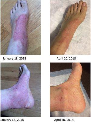 Psoriasis, Before and After Five element acupuncture treatments