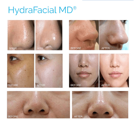 The HydraFacial will intensely improve hydration, minimize dark spots and dramatically reduce appearance of fine lines and wrinkles.