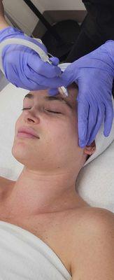 Microdermabrasion