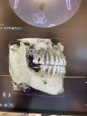 Ct Xray. Implant site.