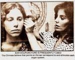 Photo from Santa Barbara newspaper 1982. First acupuncturist in Santa Barbara.