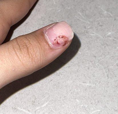 broken nail