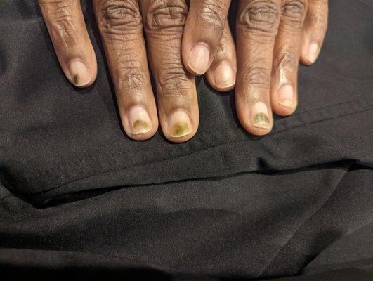 Fungus.  She was blamed for fungus growth even though the preparation was done at Royal Nails.