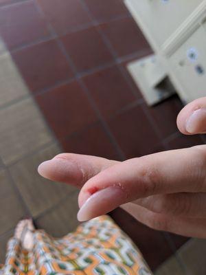 They cut a chunk of my finger