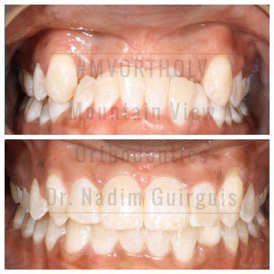 Severe underbite before/after