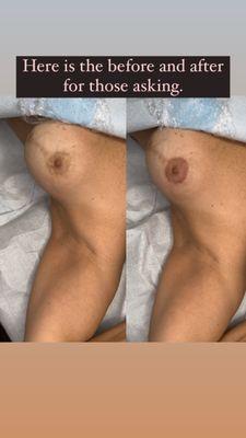 Areola restoration after breast reduction