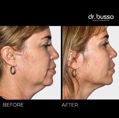 Dr. Busso's ground breaking technique, BussoLyft uses threads to lift the patient's own fat to boost the cheeks and tighten jowls.