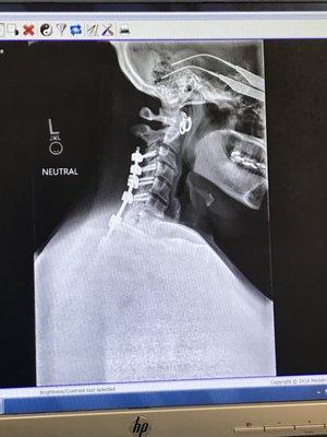 Cervical spine