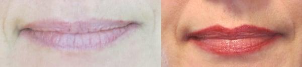 Before an after lip liner procedure