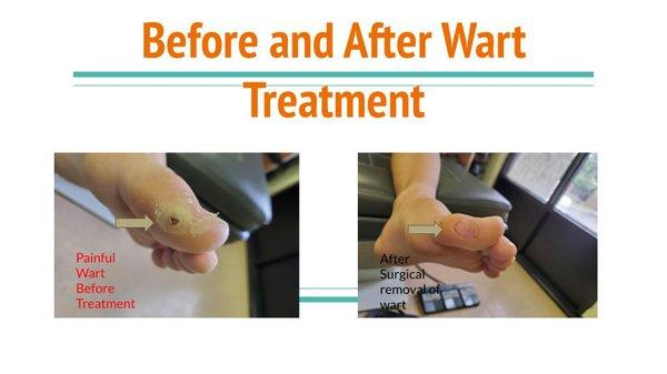 Before and After Wart Treatment