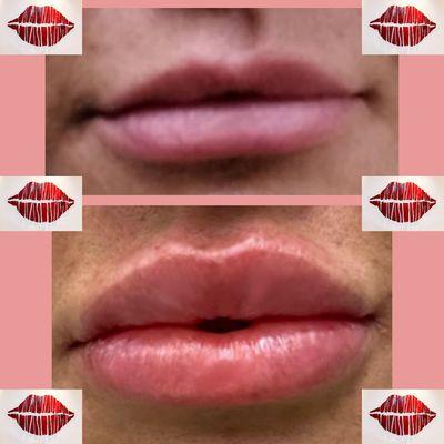 Ready to add volume to those lips? Schedule an appointment today!