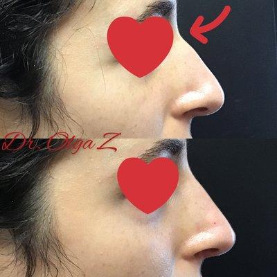 Non-surgical nose job