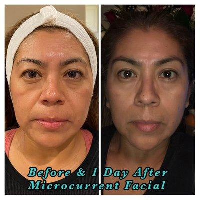 Before & a Day after Microcurrent Facial!