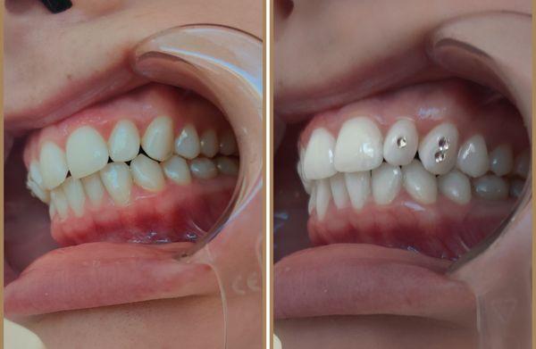 Teeth Whitening + Tooth gems