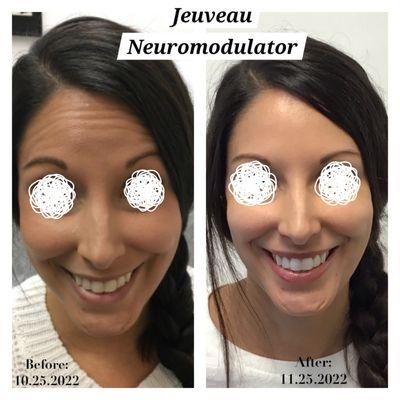 Before & After NeuroModulator Jeuveau