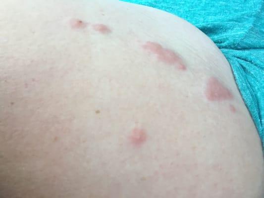 The bites from the bed bugs and the bed bugs on the bed and inside the boxsprings