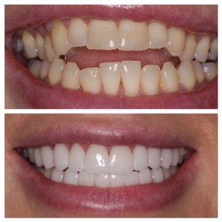 Invisalign & porcelain to correct an open bite.  Yes!!