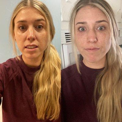 Before and After of under eye filler from Jurry. No makeup in either photo.