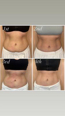 Sol Bod (skin tightening)