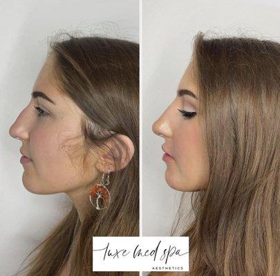 Non-Surgical Rhinoplasty (Nose Job) in Orlando, FL