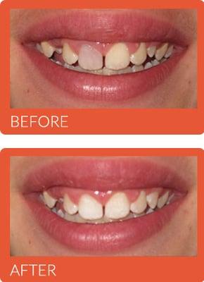 Before and After Photos - Alpine Meadows Family Dental in Lehi, UT http://www.alpinemeadowsfamilydental.com/our-office