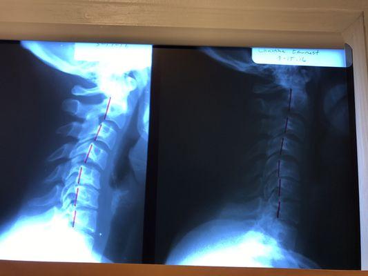 This is incredible! The pic on RT (after chiro care) shows we are now straightening out in order to begin curving the way it should!