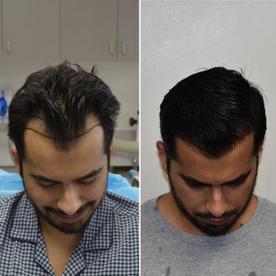 6 months post FUE Hair Transplant @50% growth. Double density still to come following next 10 months. Client had zones 1 and 2 restored.