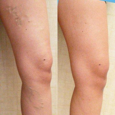 Leg varicose veins treated with EVLT by Dr. Raffi Dishakian at Nu Vela.