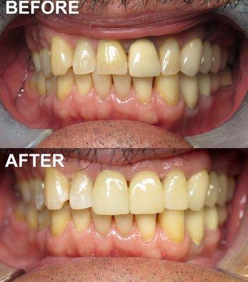 Anterior Crowns