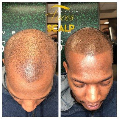 Scalp Micropigmentation by Chris