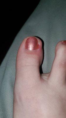 Toe was irritated and sore the next day