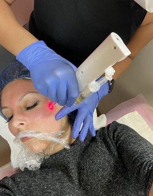 PRP facial