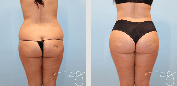 Natural Butt Lift® (LipoContouring + Fat Transfer to buttock)